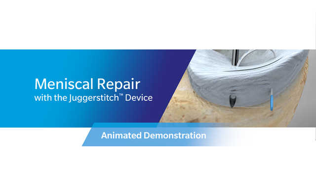 Meniscal Repair with the Juggerstitch™ Device