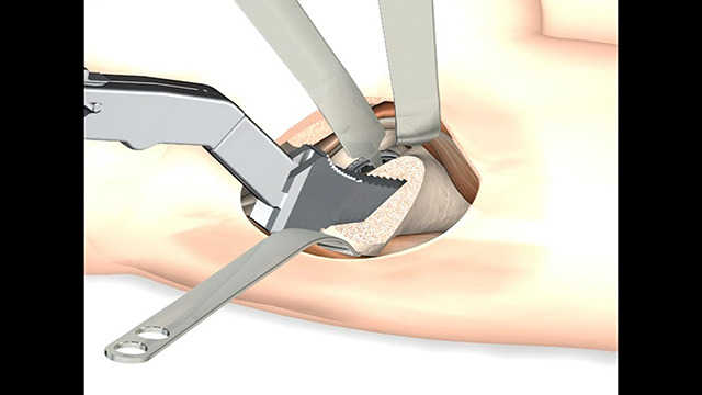 Zimmer® MIS Anterior Supine Hip Procedure 