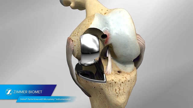 Oxford® Partial Knee Microplasty® Instrumentation Animation