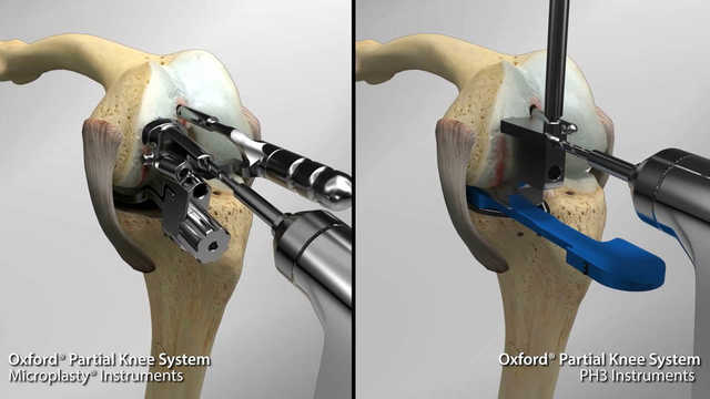 Oxford® Partial Knee System PH3 Instruments Comparison Animation