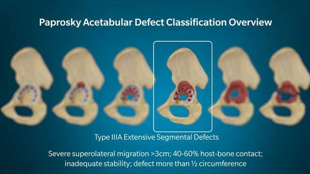 TMARS - Type IIIa extensive segmental defects