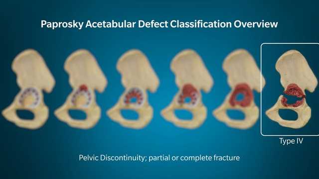 TMARS - Type IV defects Pelvis Discontinuity