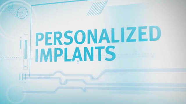 Personalized Implants 