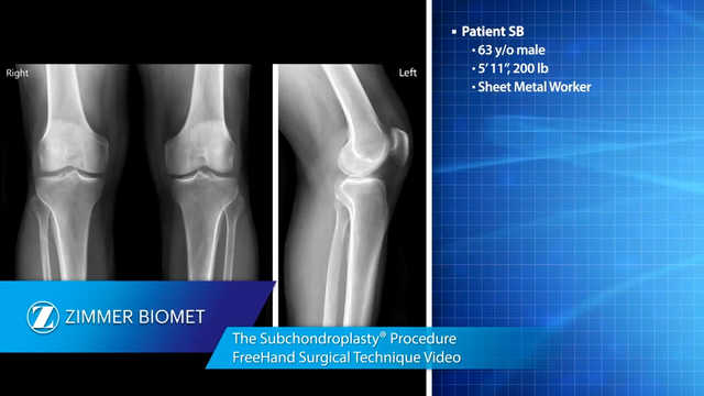 Subchondroplasty® Procedure Freehand Surgical Technique Animation