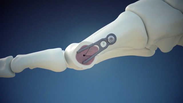 Re+Line® Bunion Correction System - Surgical Animation