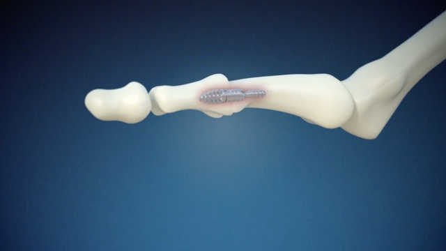 Nextra® Hammertoe Correction System - Surgical Animation