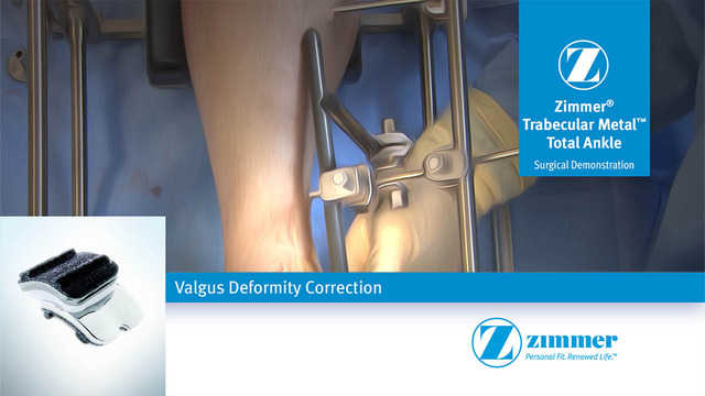 Valgus Deformity Correction for the Zimmer® Trabecular Metal™ Total Ankle