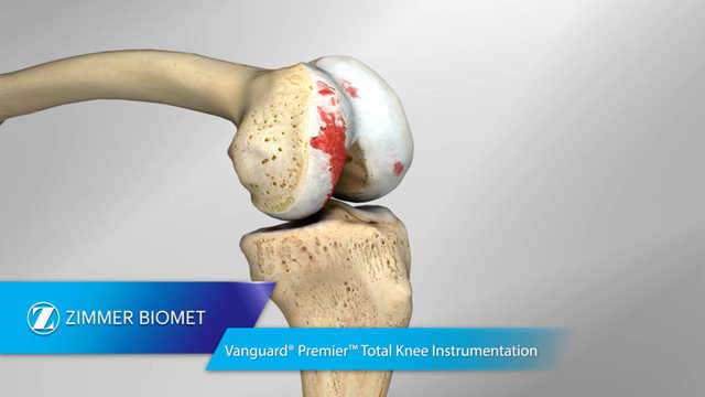 Vanguard® Premier™ Total Knee Surgical Technique Animation