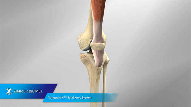 Vanguard XP® Total Knee System Animation