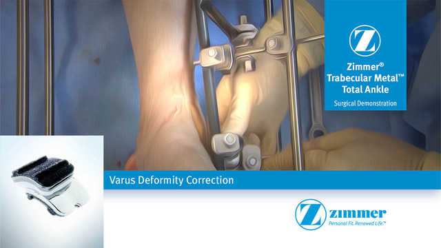 Varus Deformity Correction for the Zimmer® Trabecular Metal™ Total Ankle