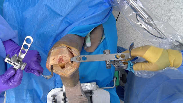 WalterLorenz® Surgical Assist Arm Total Knee Arthroplasty Surgical Demonstration