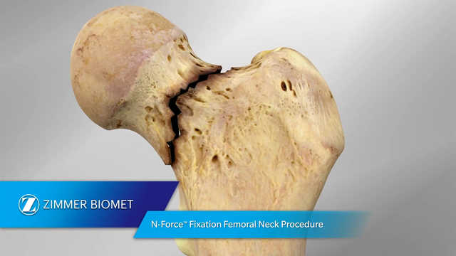 N-Force™ Fixation Femoral Neck Procedure
