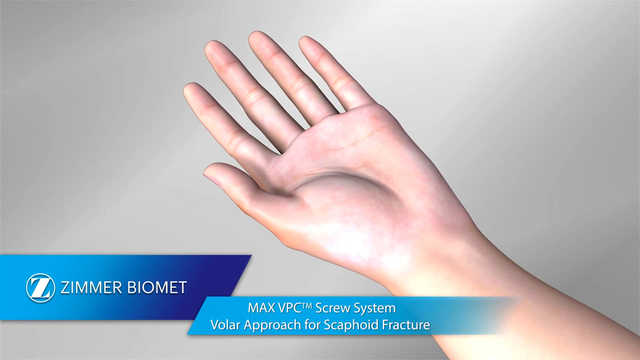 MAX VPC™ Screw System Volar Approach for Scaphoid Fracture