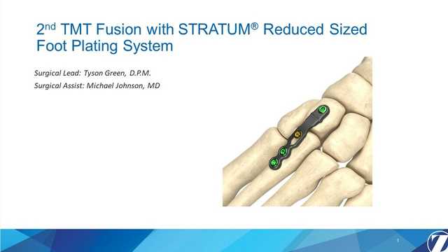 2nd TMT Fusion with Stratum Reduced Size Foot Plating System