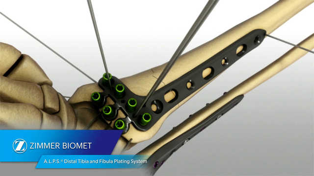A.L.P.S.® Distal Tibia and Fibula Plating System