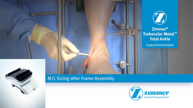 M/L Sizing after Frame Assembly for the Zimmer® Trabecular Metal™ Total Ankle