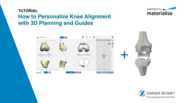 Tutorial: How to Personalize Knee Alignment with 3D Planning and Guides