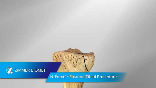 N-Force™ Fixation Tibial Procedure