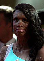 Turia Pitt Photo #1