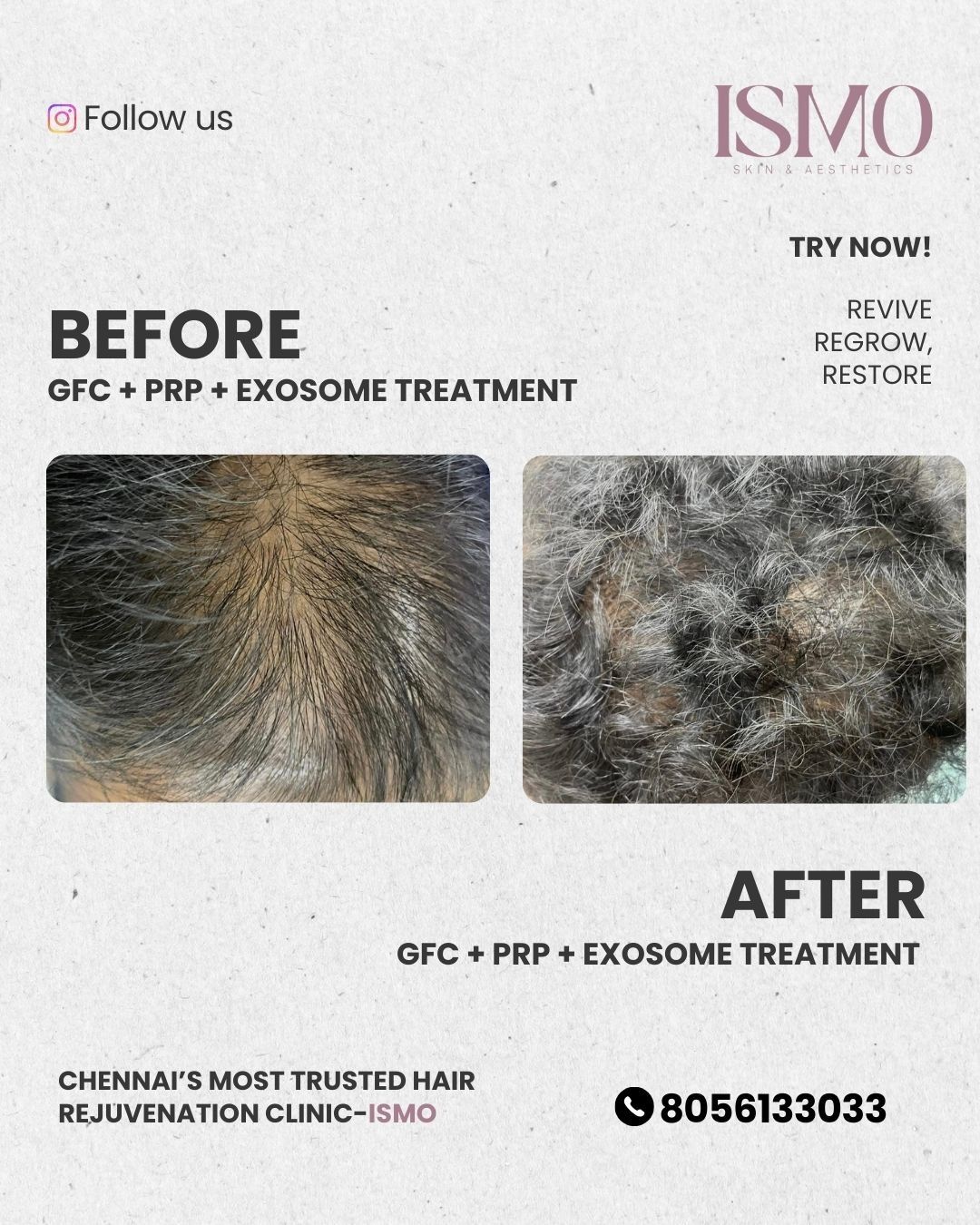 Male Pattern Hair Loss