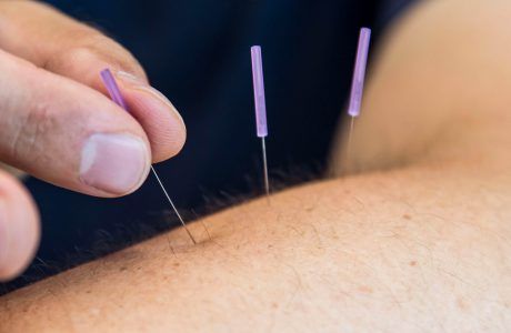 dr_doyscher_orthopaedie_dry_needling