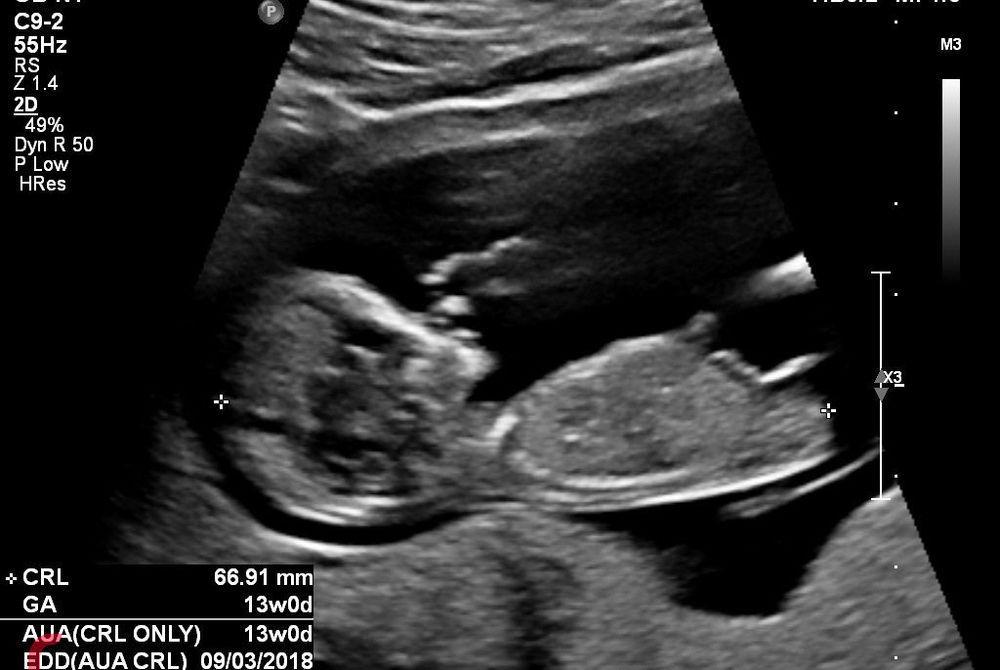 ބަނޑުގައި އޮތް ކުއްޖެއްގެ އަލްޓްރާސައުންޑް އިމޭޖެއް