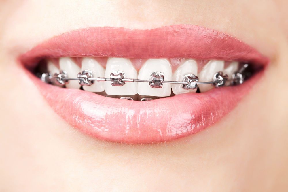 Close-up of traditional metal braces on teeth