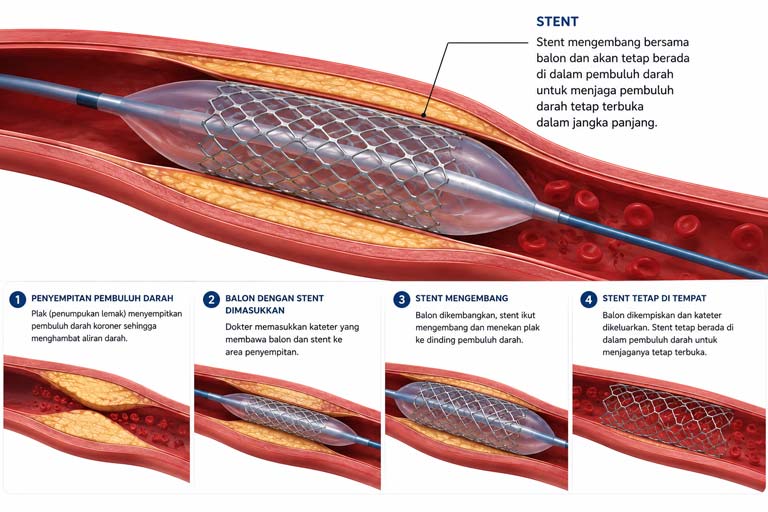 Stent Jantung