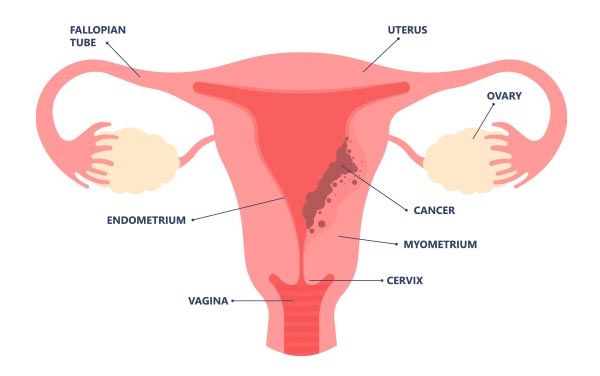 Visualisasi Kanker Endometrium