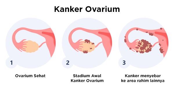 Gambar Kanker Ovarium