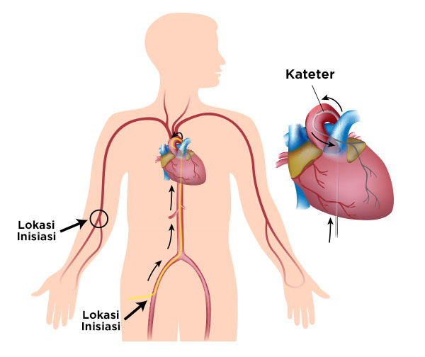 Visualisasi Kateterisasi Jantung