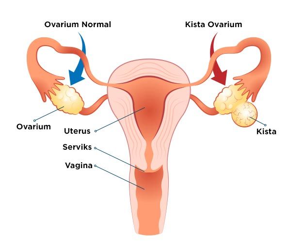 Gambar Kista Ovarium