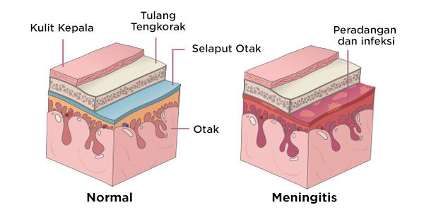 Visualisasi Kondisi Selaput Otak pada Penyakit Meningitis