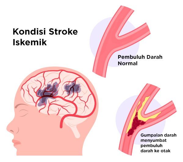 Gambar Stroke Iskemik
