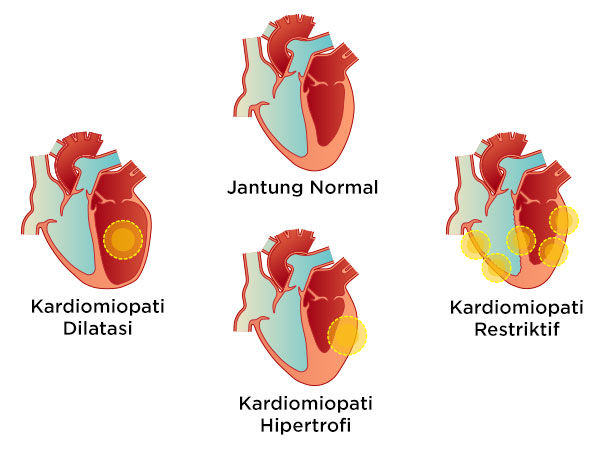 Gambar Jenis Kardiomiopati