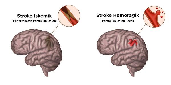 Jenis Stroke