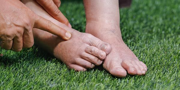 Pembengkakan pada kaki