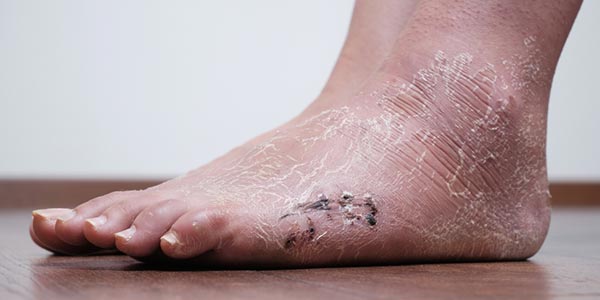 Kaki gatal diabetes - kaki kering