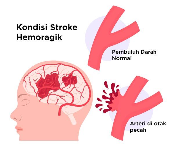 Gambar Stroke Hemoragik