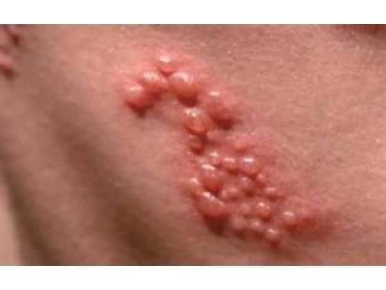 11 Critical Facts To Help You Manage Shingles Virus