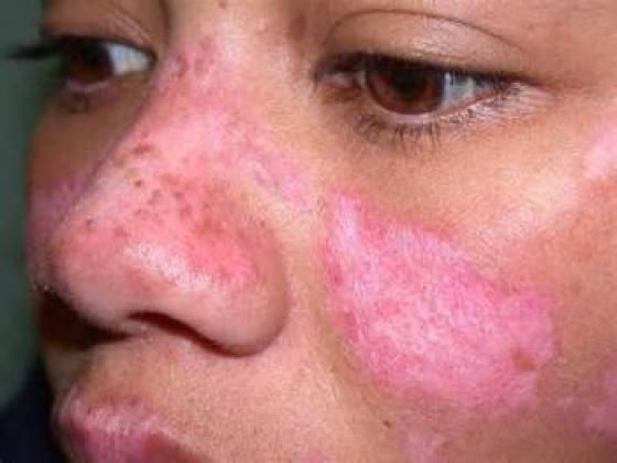 Caring For Lupus Affected Skin