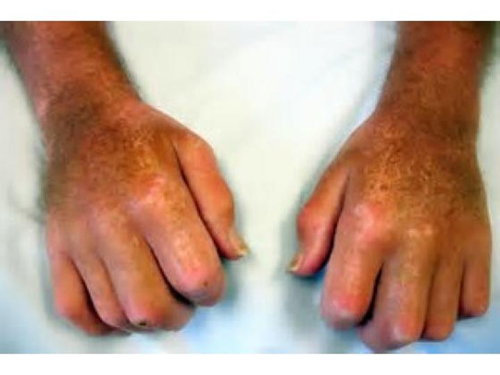 Scleroderma A Complex Challenging Condition