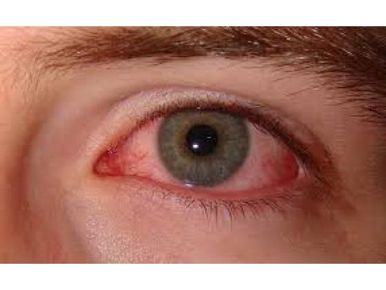 Red Inflamed Eyes Needs Prompt Attention
