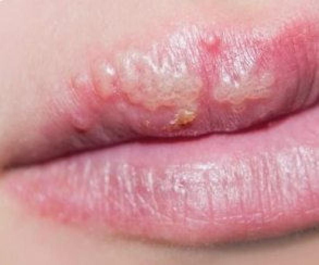 Deal Swiftly With Cold Sore Outbreaks