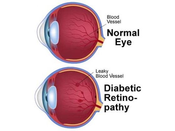Diabetes And Your Vision Health