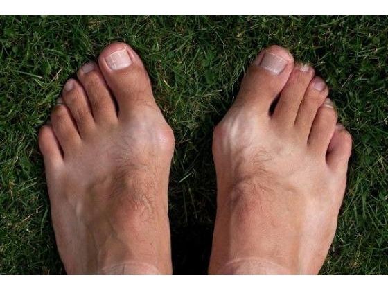 DIY Care For Distressingly Painful Bunions