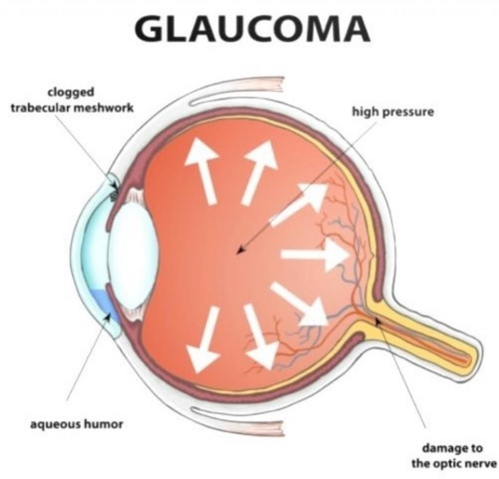 Glaucoma Can Steal Your Eyesight