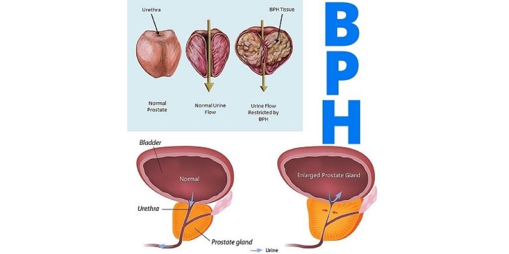 Men Learn More About Of BPH