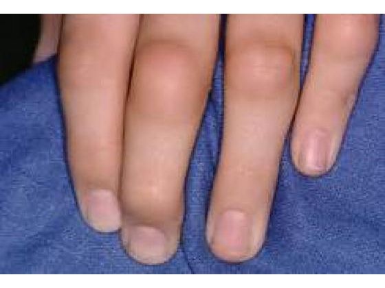 Outsmart And Calm Rheumatoid Arthritis Pain
