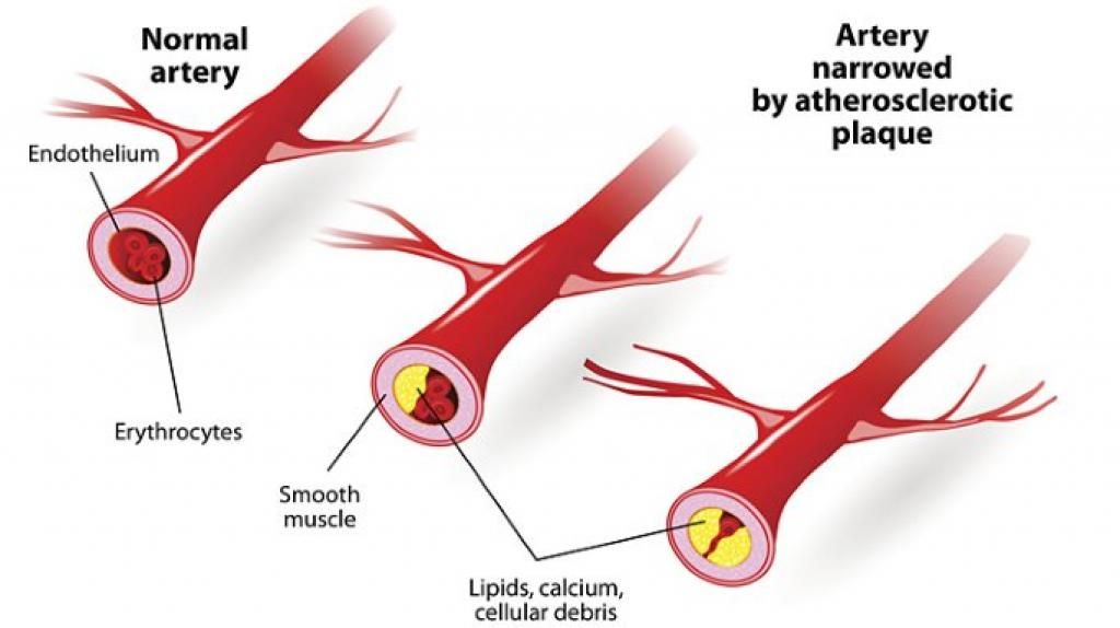 Prevent Coronary Artery Disease Food Choices Matter